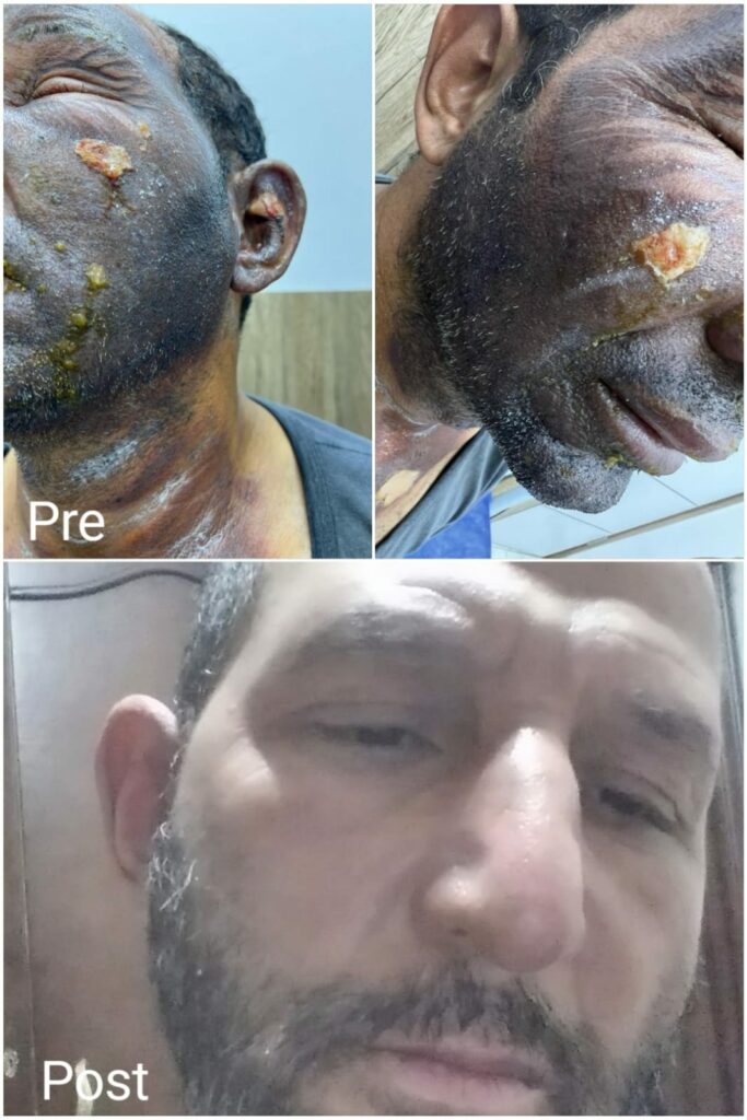 The best doctors for treating burns